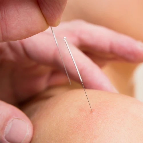 Chiropractic Brampton ON Acupuncture